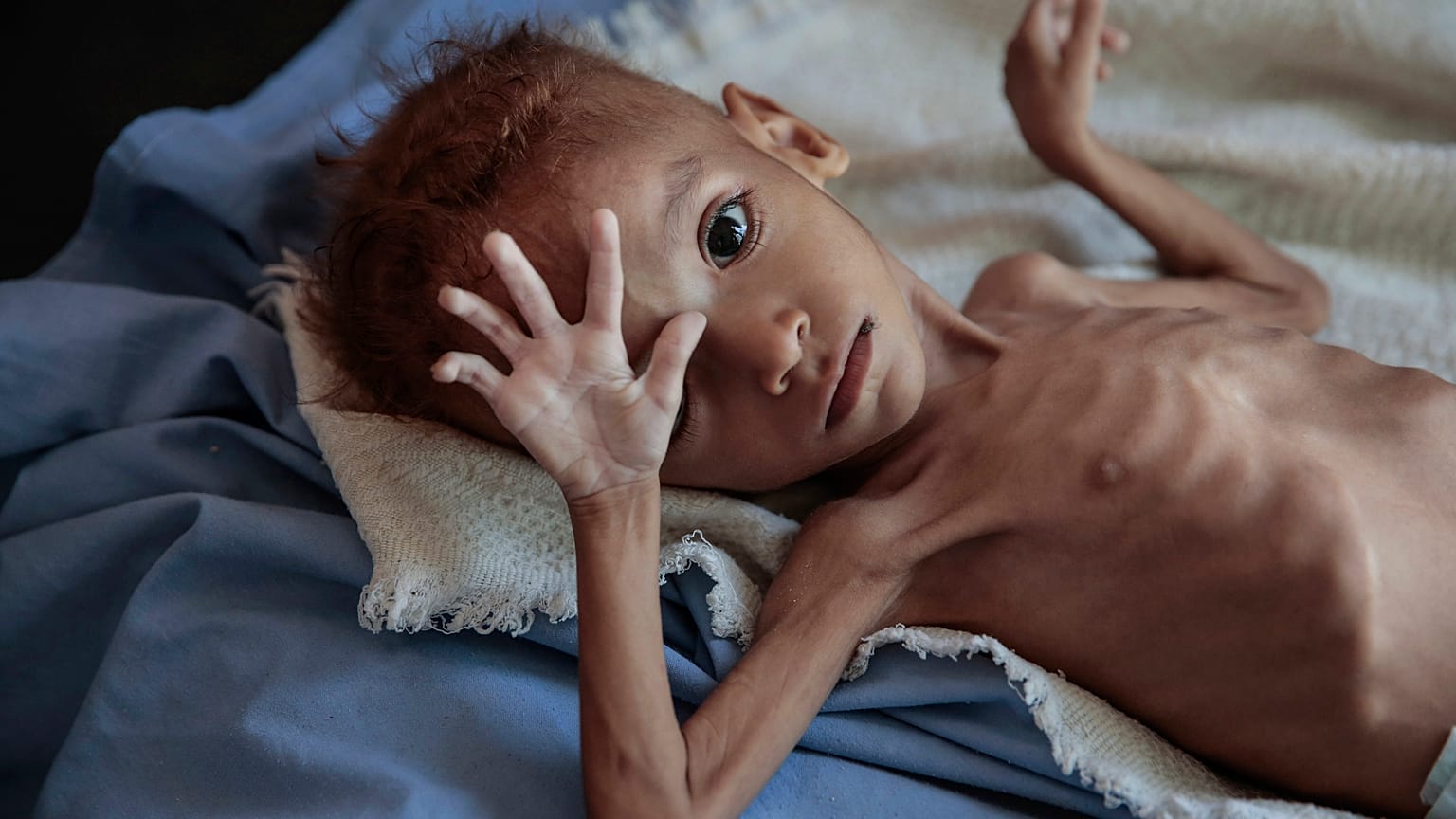 Selon l’ONU, 24 millions de Yéménites ont besoin d'aide humanitaire