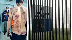 I segni delle brutalità sul corpo di un migrante intervistato dal Danish Refugee Council a Velika Kladusa, Bosnia: accusa la polizia croata di percosse e violenze