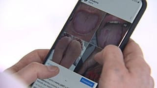 لسان مرضى مصابين بفيروس كورونا المستجد