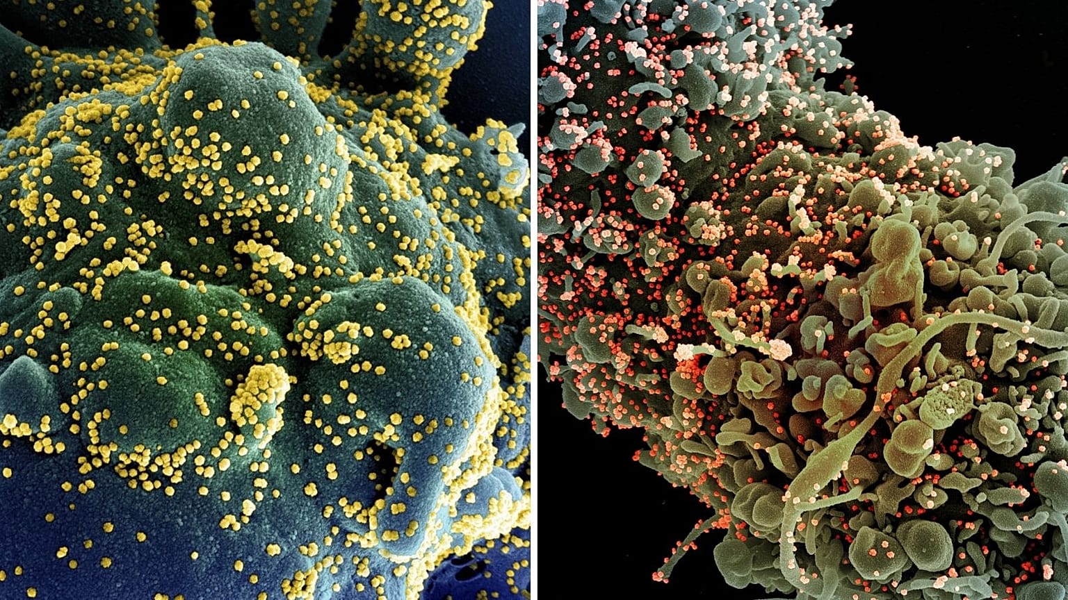 Cellule infettate dal Sars-CoV-2. Il virus si attacca attraverso una proteina, Spike, resa "inoffensiva" dagli anticorpi monoclonali