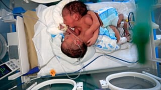 ولادة  توأمين سياميين في اليمن ونقلهم إلى الأردن- أرشيف