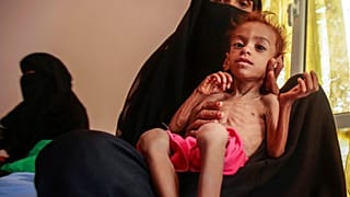 In this Oct. 1, 2018 file photo, a woman holds a malnourished boy at the Aslam Health Center, in Hajjah, Yemen