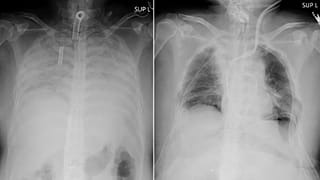 This combination of radiographs provided on April 9, 2021, by Kyoto University Hospital, shows the chest of a patient before the surgery, left, and after the surgery, right.