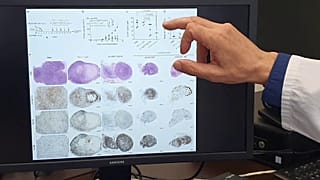 Diferencias ante el mismo tumor en ratones con y siin trimerbodies