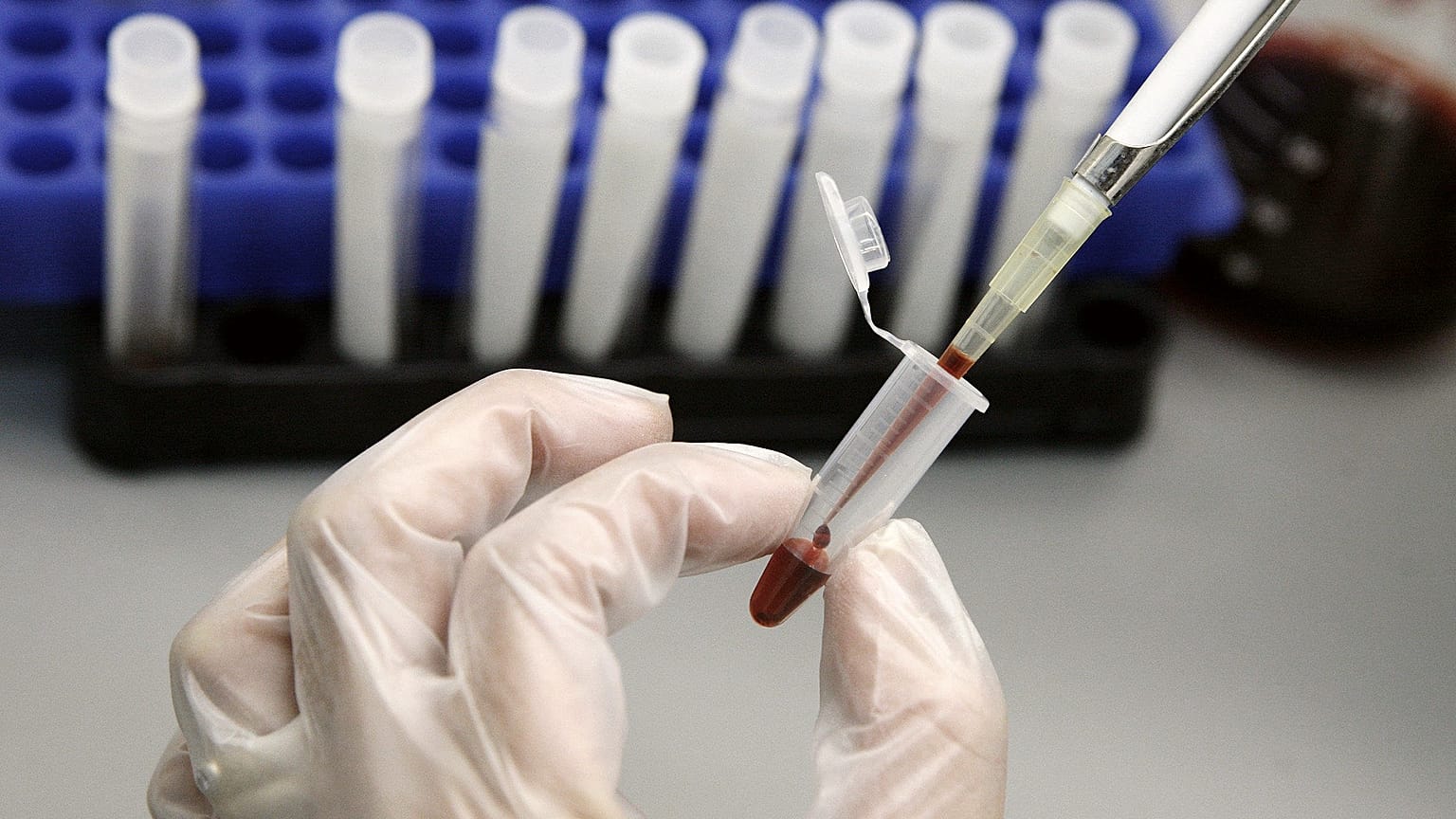 HIV ve AIDS testi