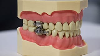 تُظهر هذه الصورة من جامعة أوتاغو جهازًا لإنقاص الوزن ابتكره باحثون نيوزيلنديون يستخدم المغناطيس لربط الفكين، نيوزيلاندا، 29 يونيو 2021