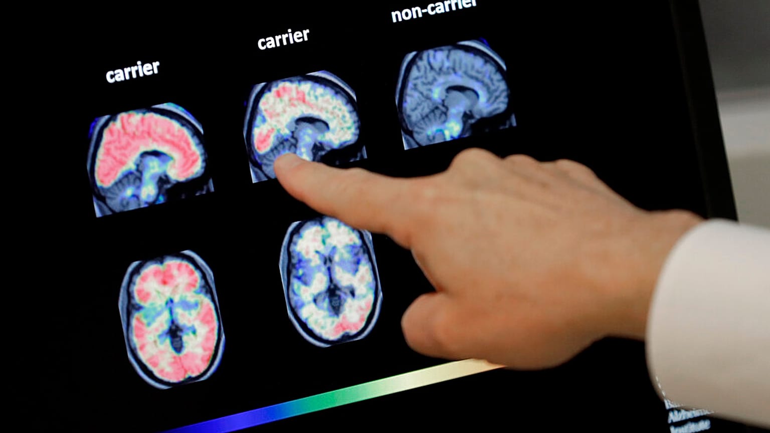 Yeni geliştirilen "lecanemab" adlı ilaç Alzheimer tedavisinde çığır açabilir