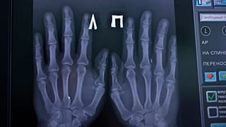 A photo of an X-ray of the electronic chips Russian doctor Aleksandr Volchek has implanted into his hands and wrist,