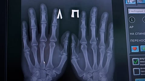 A photo of an X-ray of the electronic chips Russian doctor Aleksandr Volchek has implanted into his hands and wrist,