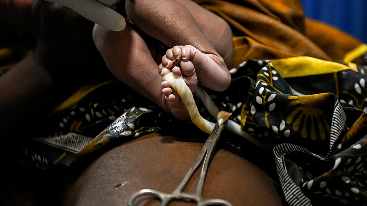 Nacimiento de un bebé en Malawi