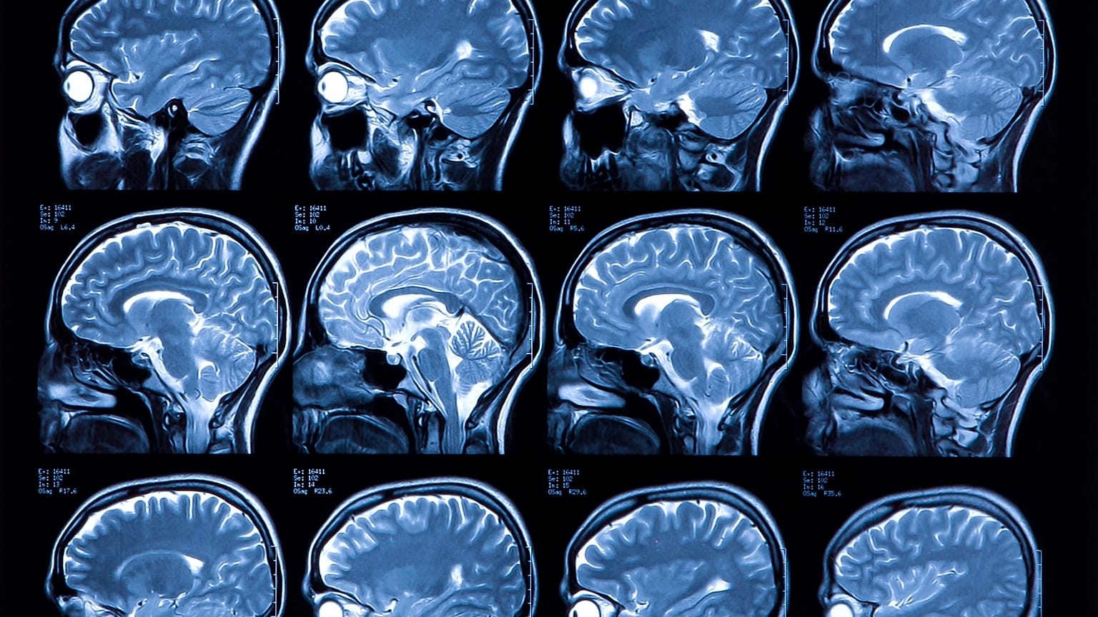 The detail from MRI scans of a patient's head.