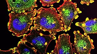 Metastatik melanoma hücresi