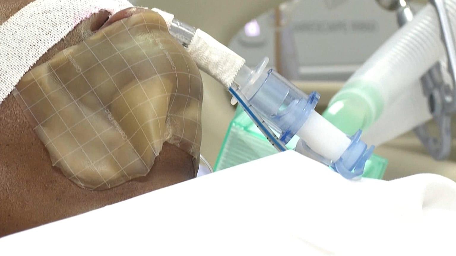 Guadeloupe : dans un service de réanimation saturé qui fait face à l'explosion des cas