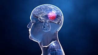 A lab in the University of Tel Aviv is 3D-printing brain tumours in order to trial new treatments for Glioblastoma, an agressive form of brain cancer. 