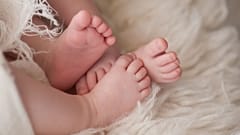 دو قلوهای یکساله اسرائیلی که از سر بهم چسبیده بودند از هم جدا شدند