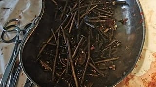 الأجسام المعدنية التي أزيلت من معدة رجل لتواني 