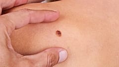 La prevenzione è essenziale: anche per il melanoma cutaneo. 