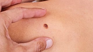 La prevenzione è essenziale: anche per il melanoma cutaneo. 