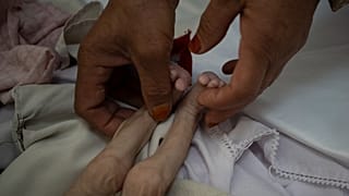 پاهای یک دختر ۴ ساله افغان که از گرسنگی رنج می برد