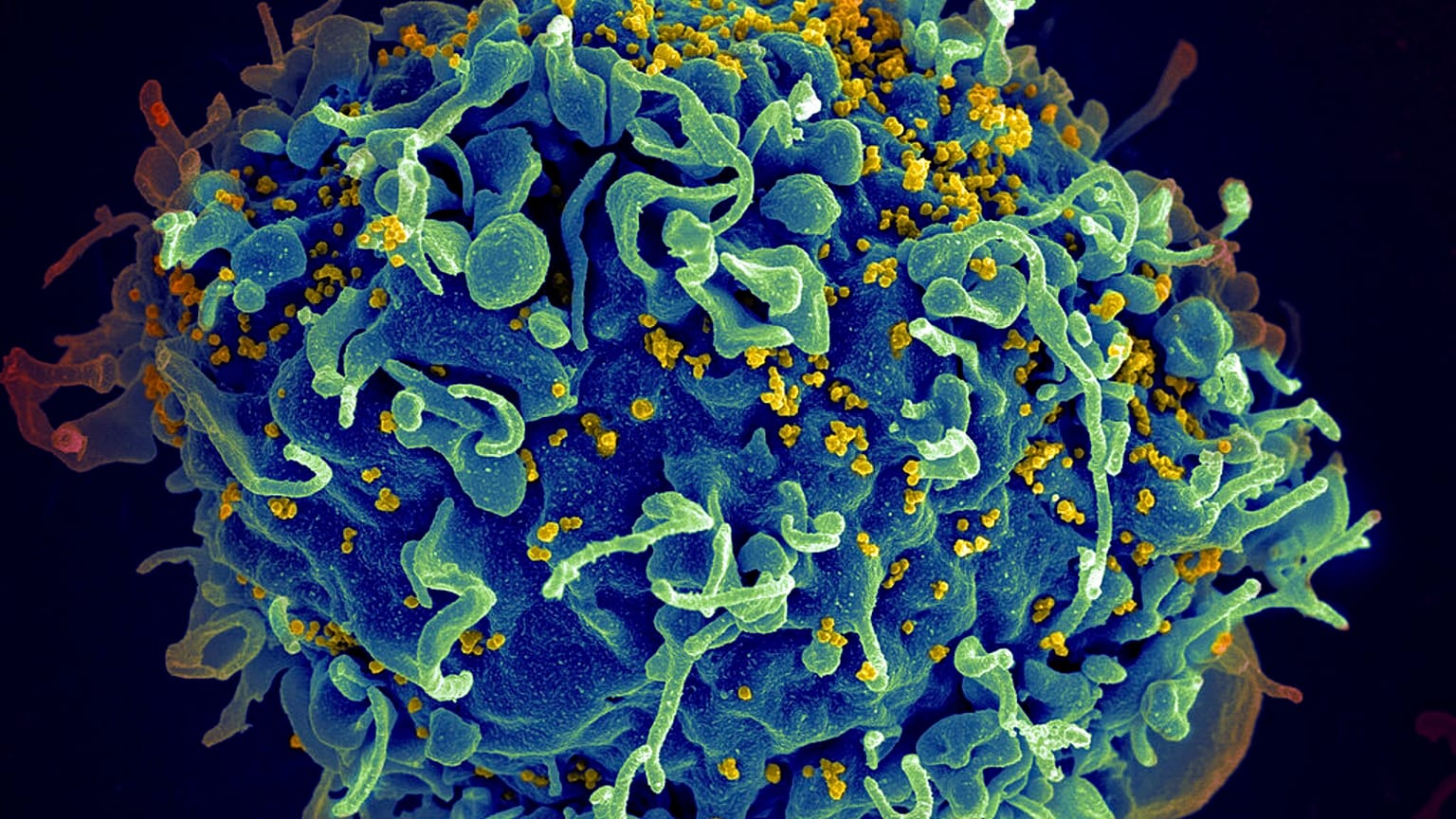 HIV virüsü saldırısı altındaki bir T hücresinin elektron mikroskobundan görüntüsü