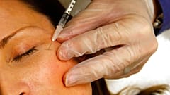 Injektion von Botox - ARCHIV