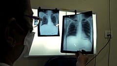 Lungenerkrankungen: Furcht vor Corona schadet Tuberkulose-Vorsorge 