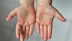 افزایش شمار مبتلایان به سرخک در جهان