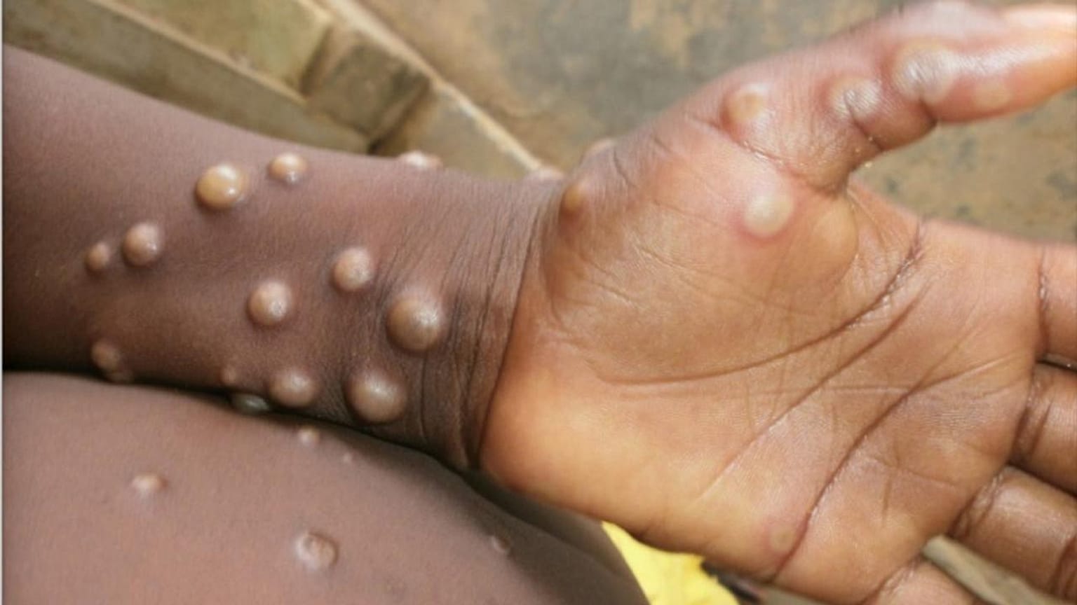 Ce rare virus lié à la variole provoque des symptômes pseudo-grippaux et une éruption cutanée désagréable, et il peut être mortel.