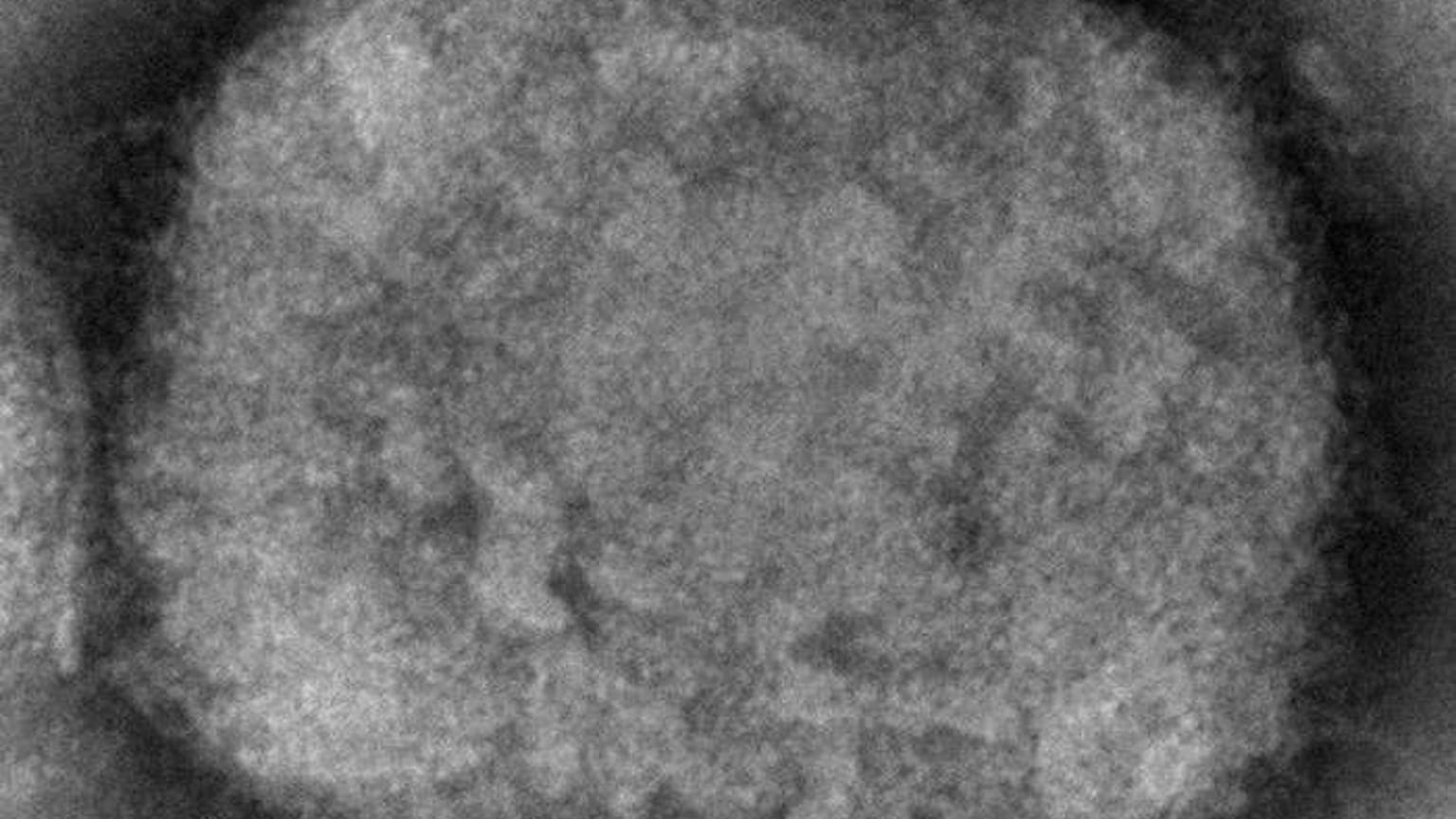  كندا تسجل أوّل حالتَي إصابة بمرض جدري القردة 