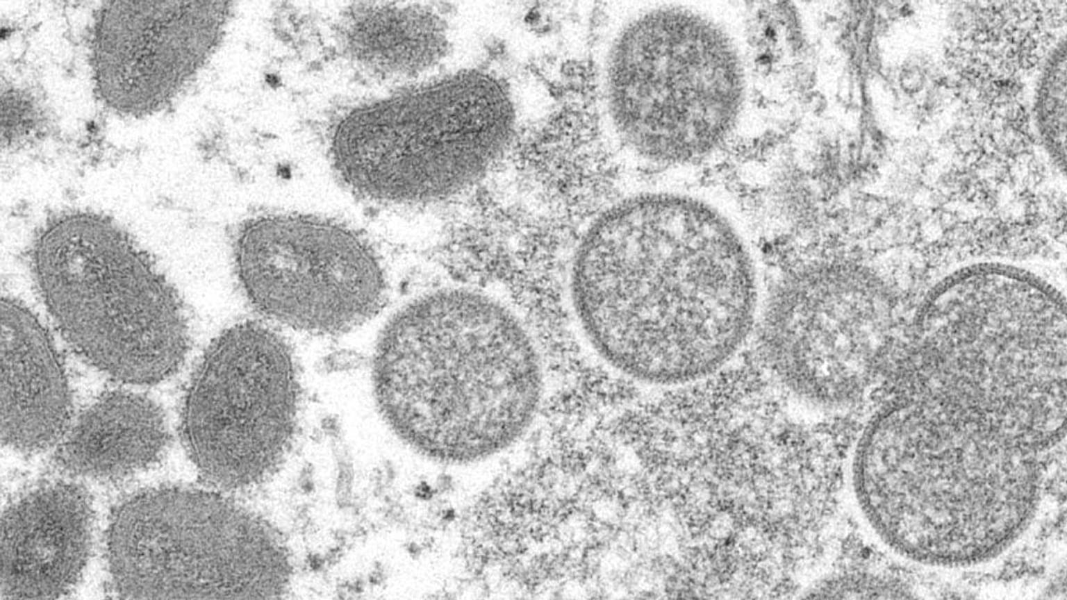 The number of confirmed cases of the monkeypox, a virus related to smallpox that is typically limited to Africa, is growing.