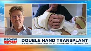 Double hand transplant
