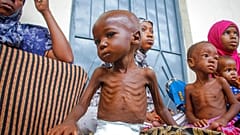 Niño afectado por la desnutrición aguda severa en Somalia