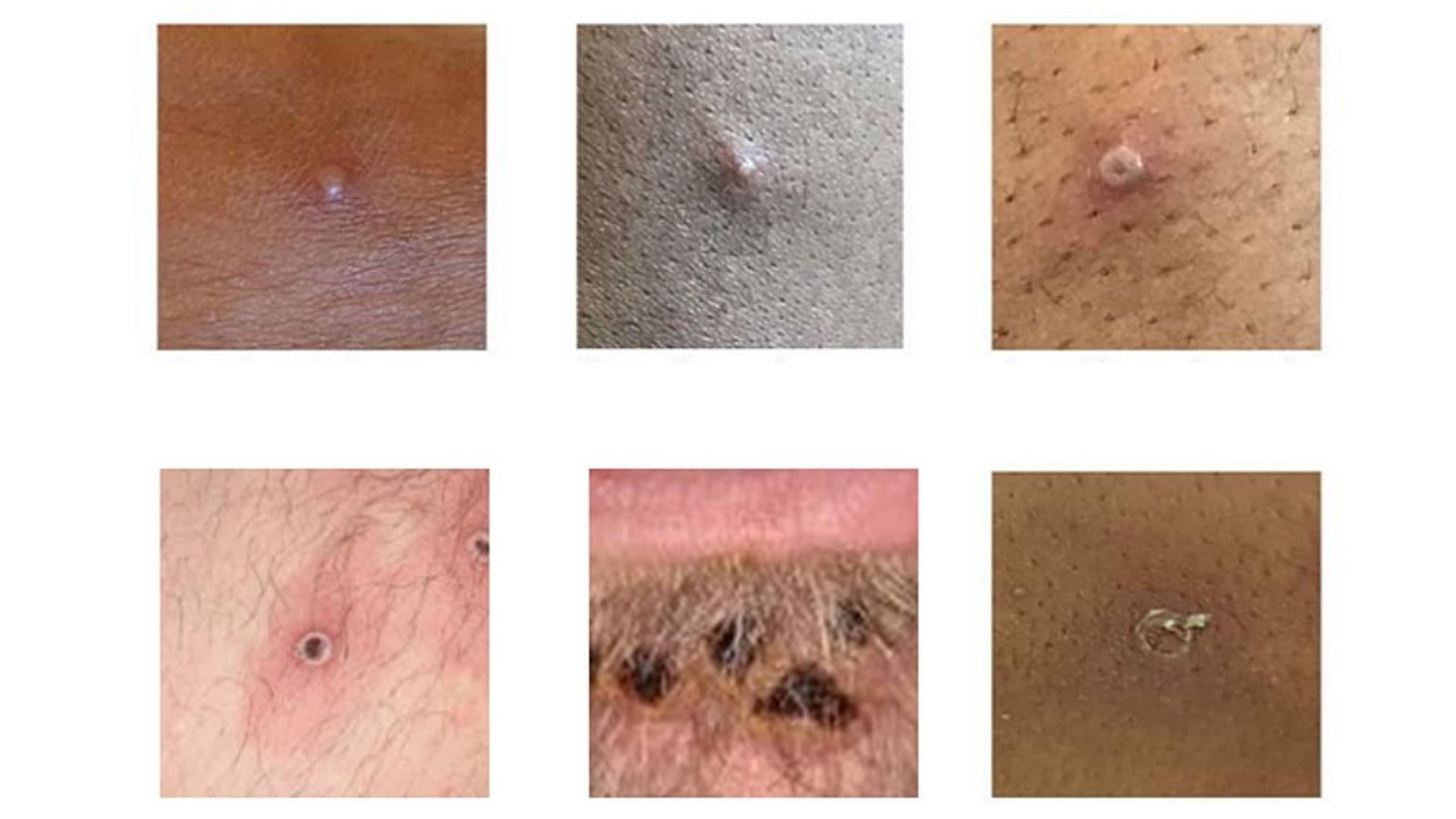 Scientists are warning that this outbreak of monkeypox is different from past ones, with symptoms that could lead to mistaking the virus for an STD. 