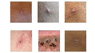 Scientists are warning that this outbreak of monkeypox is different from past ones, with symptoms that could lead to mistaking the virus for an STD. 