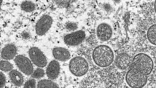 This 2003 electron microscope image from the Centers for Disease Control and Prevention shows mature, oval-shaped monkeypox virions, left, and spherical immature, right.