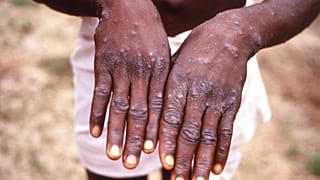 صورة من الارشيف- مريض مصاب بجدرى القرود خلال مرحلة التعافي