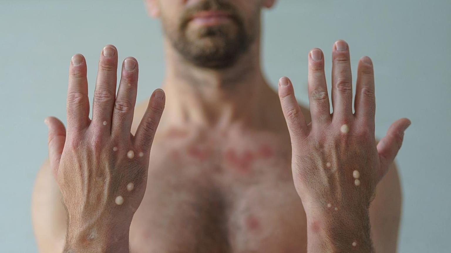 Over 1,000 cases of monkeypox have been recorded in New York, the epicentre of the United States' biggest outbreak of the virus.