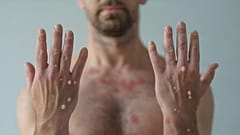 Over 1,000 cases of monkeypox have been recorded in New York, the epicentre of the United States' biggest outbreak of the virus.