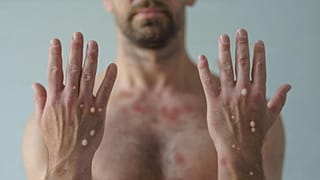 Over 1,000 cases of monkeypox have been recorded in New York, the epicentre of the United States' biggest outbreak of the virus.