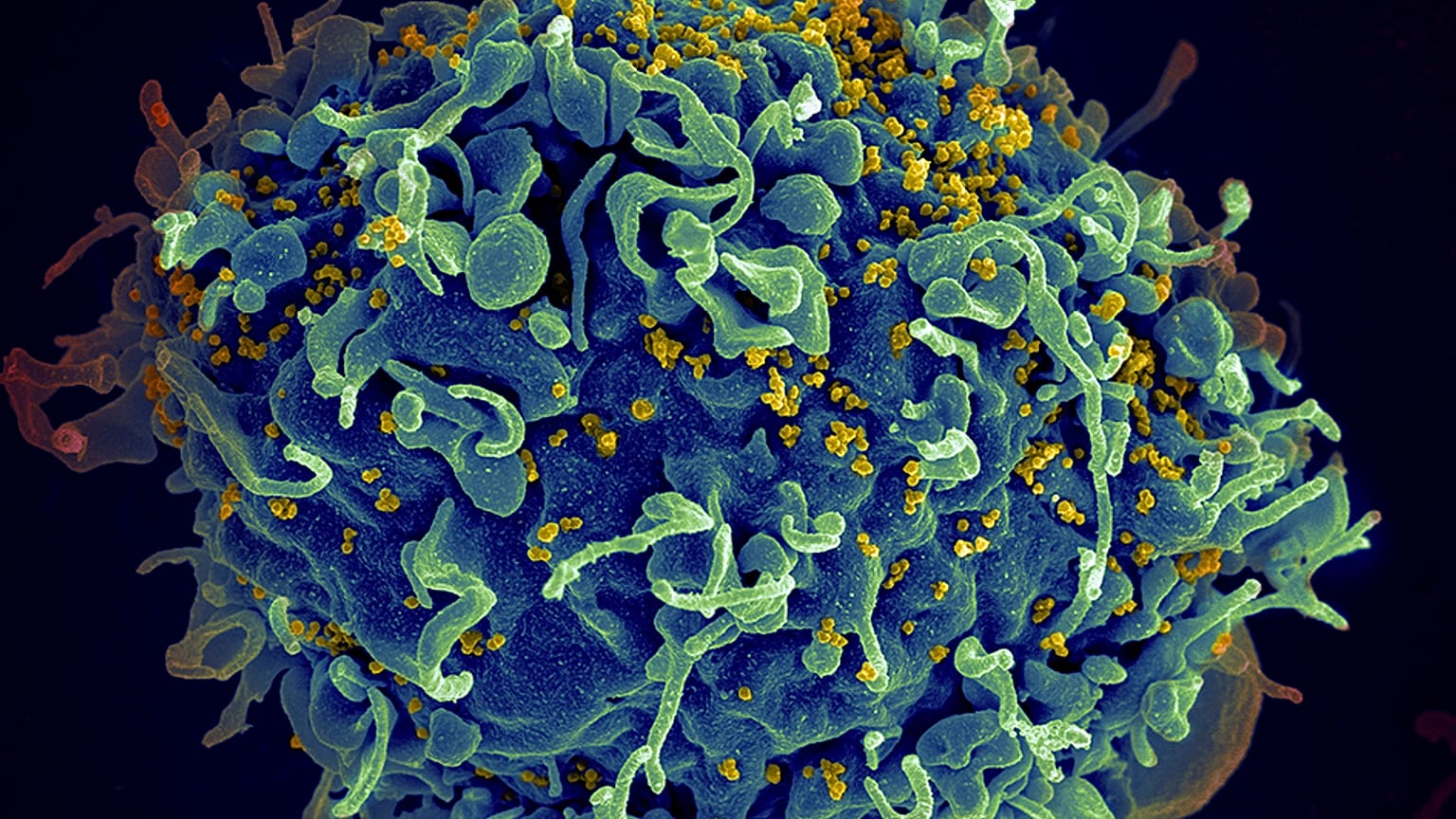 The UN has raised the alarm over efforts to prevent new HIV infections stalling during the pandemic.
