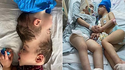 A pair of conjoined twins were successfully separated after nine complex surgeries in Brazil.