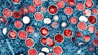 Eine kolorierte Transmissionselektronenmikroskopie von Affenpockenpartikeln, National Institute of Allergy and Infectious Diseases (NIAID).