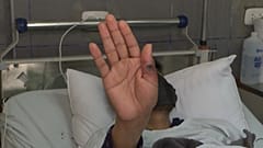 Foto de uno de los pacientes ingresado en Perú debido a la viruela del mono