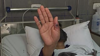 Foto de uno de los pacientes ingresado en Perú debido a la viruela del mono
