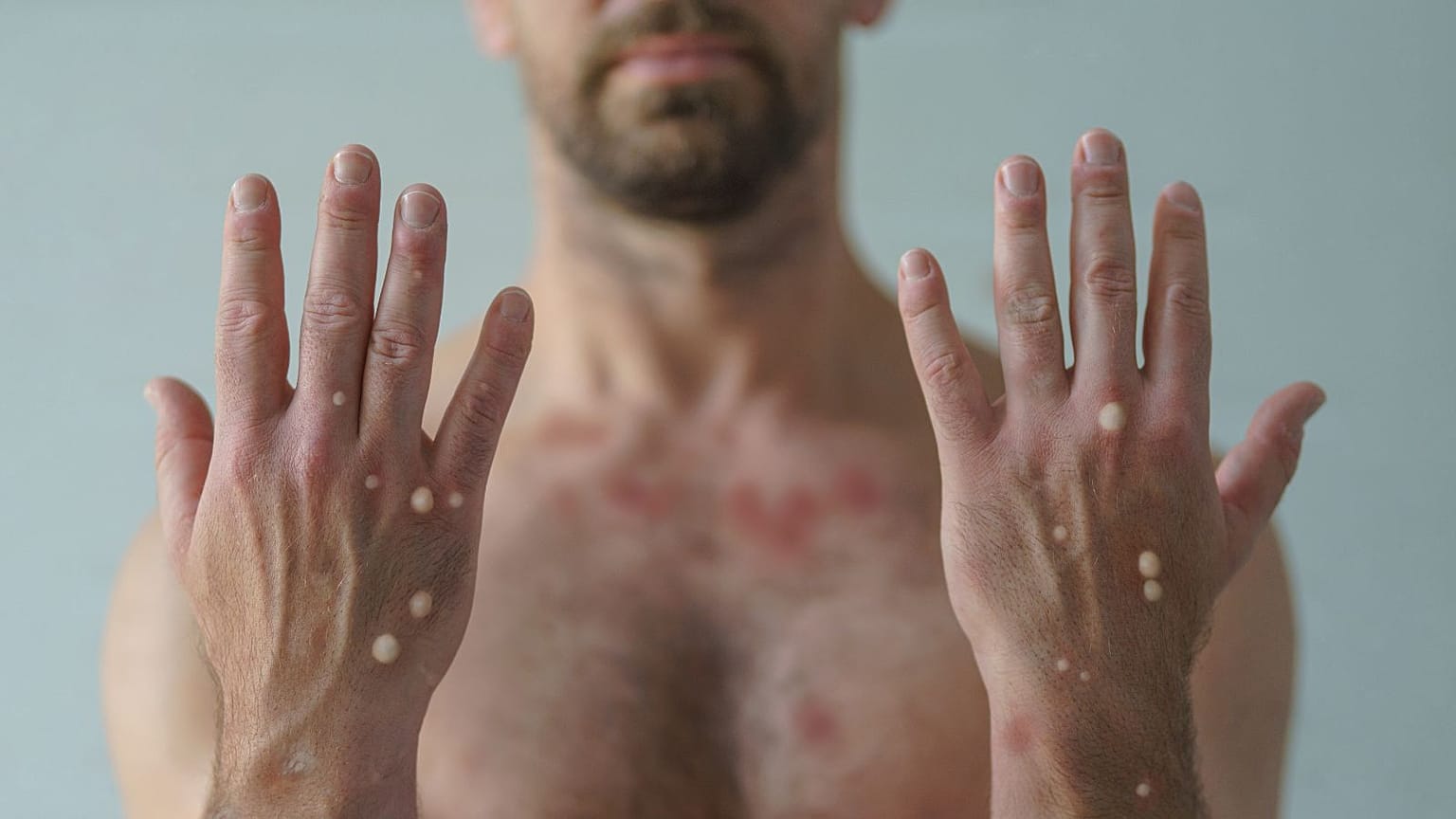 The WHO has launched an open call to rename monkeypox.