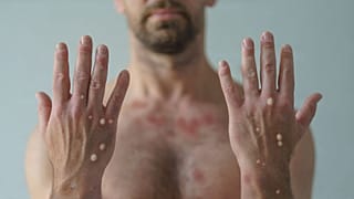 The WHO has launched an open call to rename monkeypox.