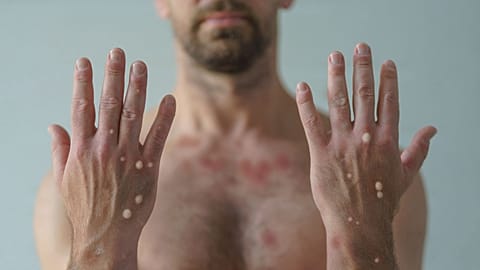 The WHO has launched an open call to rename monkeypox.