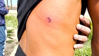 Un migrante venezolano muestra la herida que le produjo una bala de goma.
