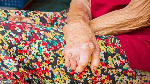 Leprosy can cause disfiguring sores, but the bacteria behind it may actually hold the secret to safely regenerating body tissue, scientists say.