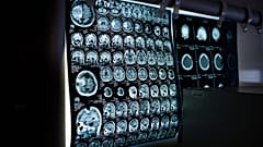 With NVision's Metabolic MRI, cellular changes can be seen within seven days.